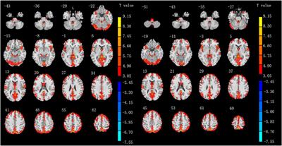 Altered Spontaneous Brain Activity Patterns and Functional Connectivity in Adults With Intermittent Exotropia: A Resting-State fMRI Study